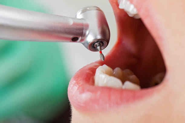 Best Knocked-Out Tooth (Avulsed Tooth) Treatment in Brass Castle, NJ